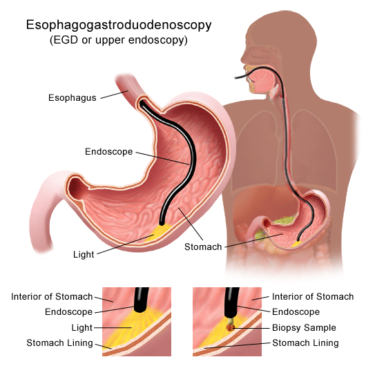 EGD